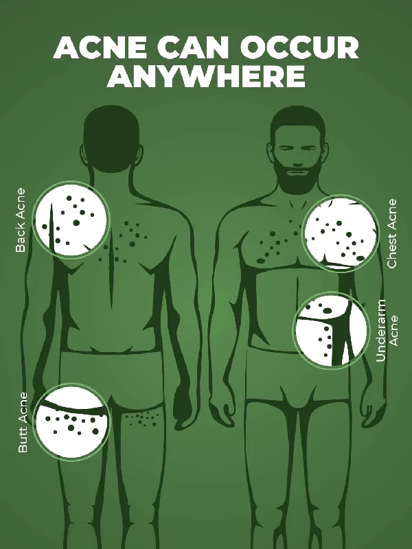 Beardo Body Acne Clear Body Wash for Men, 200 ml-6.webp